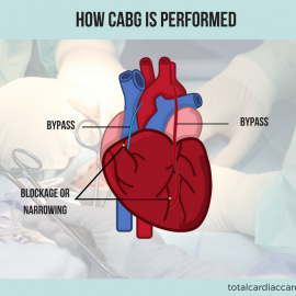 How is CABG performed?