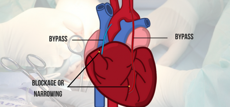 How is CABG performed?