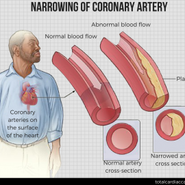 What Is Bypass Surgery And Why Is It Performed?