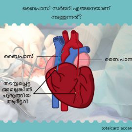 ബൈപാസ് സർജറി എങ്ങനെയാണ് നടത്തുന്നത് ? – Total Cardiac Care | Dr.Mahadevan Ramachandran ബൈപാസ് സർജറി എങ്ങനെയാണ് നടത്തുന്നത് ? – Total Cardiac Care | Dr.Mahadevan Ramachandran
