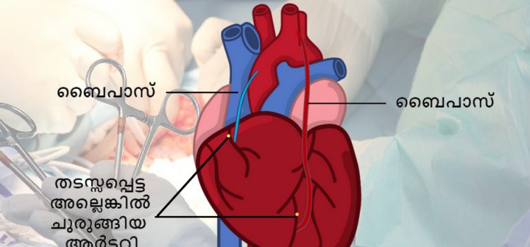 ബൈപാസ് സർജറി എങ്ങനെയാണ് നടത്തുന്നത് ? – Total Cardiac Care | Dr.Mahadevan Ramachandran