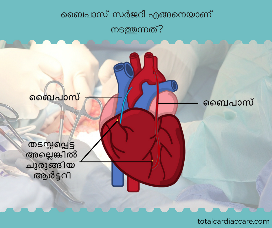 ബൈപാസ് സർജറി എങ്ങനെയാണ് നടത്തുന്നത് ? - Total Cardiac Care