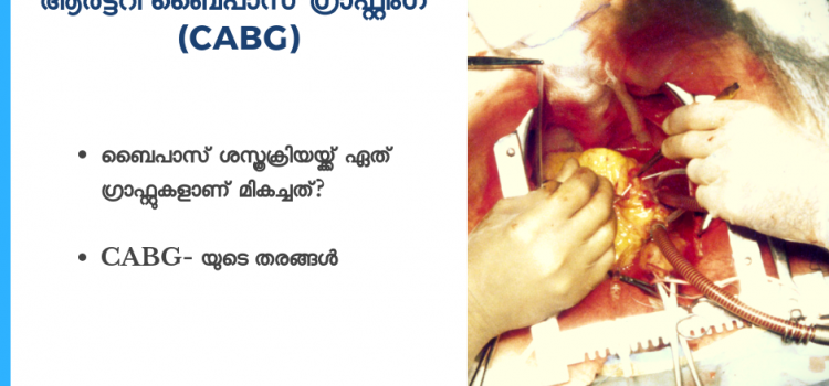 ബൈപാസ് ശസ്ത്രക്രിയയ്ക്ക് എന്ത് തരം ഗ്രാഫ്ടുകള്‍ ഉപയോഗിക്കാം? – Total Cardiac Care | Dr.Mahadevan Ramachandran