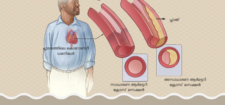 ‘ബൈപാസ് സർജറി’ യെക്കുറിച്ച് നിങ്ങൾ കേട്ടിരിക്കണം, എന്നാൽ ഈ സർജറി എന്തുകൊണ്ടാണെന്ന് ചെയ്യുന്നത് എന്ന് അറിയാമോ? – Total Cardiac Care | Dr Mahadevan Ramachandran