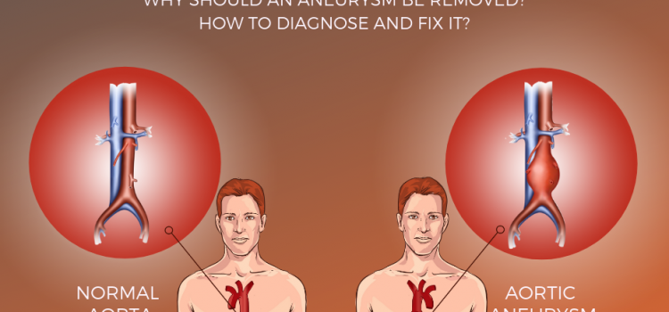 What is Aortic Aneurysm? | Total Cardiac Care What is Aortic Aneurysm? | Total Cardiac Care