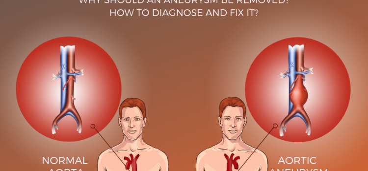 What is Aortic Aneurysm? | Total Cardiac Care