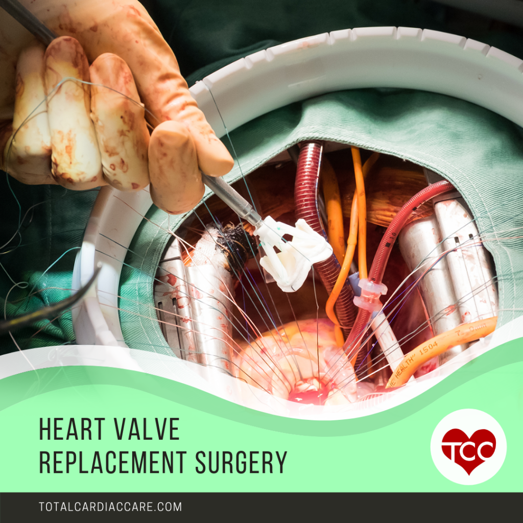 Heart Valve Replacement - Dr.Mahadevan _ Cardiac Surgeon, Trivandrum _Total cardiac care- Heart valve replacement surgery is one of the most common surgeries cardiac surgeons and some specialized cardiologists perform to fix problems with the heart valves and restore the heart’s function. To understand heart valve replacement surgery, you need to understand the basic structure and function of the heart. Basic Structure of the Heart The heart is a bag of muscle that pumps blood to all parts of your body. The heart has four chambers – two atria (singular: atrium) and two ventricles.  The atria lie above the ventricles, where they receive blood into the heart while the ventricles pump blood away from the heart. Each atrium is connected to one ventricle on one side through a passageway enclosed by a valve. The valve between the right atrium and ventricle is called the tricuspid valve while the valve between the left atrium and ventricle is called the bicuspid valve. The left ventricle pumps blood through a large vessel called the aorta, which supplies blood to all the body tissues through several arterial branches. The valve enclosing the passageway between the left ventricle and the aorta is called the aortic valve. Similarly, the right ventricle pumps blood to the lungs through the pulmonary artery to receive oxygen. The valve between these two structures is called the pulmonic or pulmonary valve. Reasons for Heart Valve Replacement Surgery