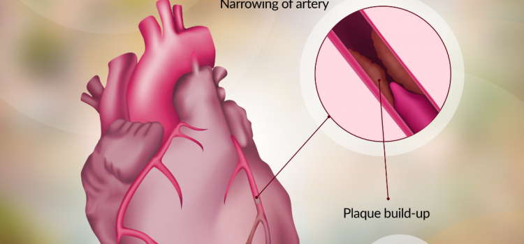 Understanding Coronary Artery Disease (CAD) | Total Cardiac Care by Dr Mahadevan